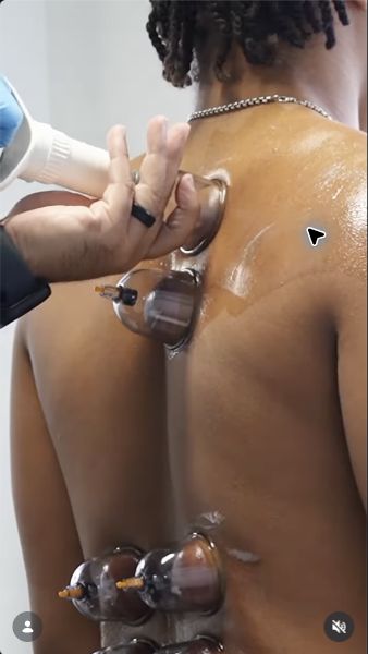 Cupping therapy performed at Stretch Room PR